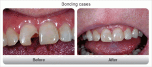 before bonding tooth chipped teeth filling broken dental restorative treatments material treatment minor bridge crowns