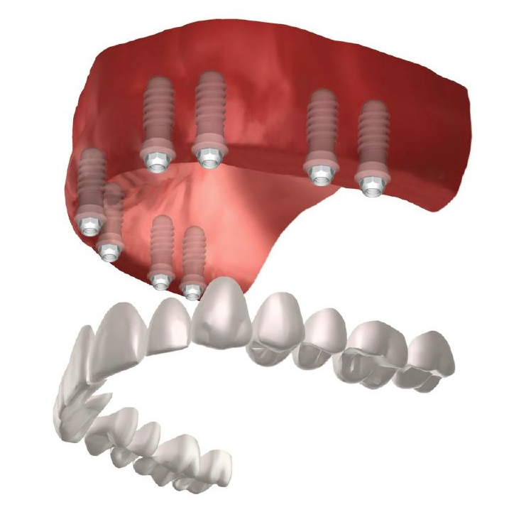 Full Mouth Dental Implant 16
