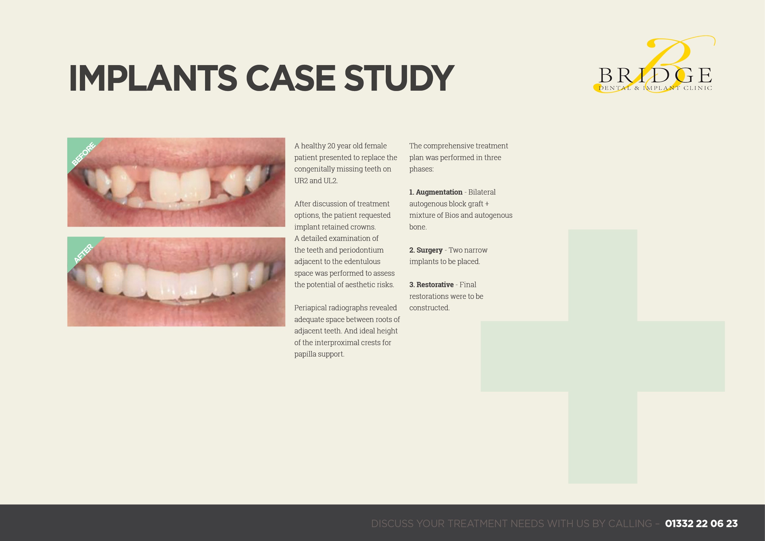 Implants Case Study - Bridge Dental Clinic