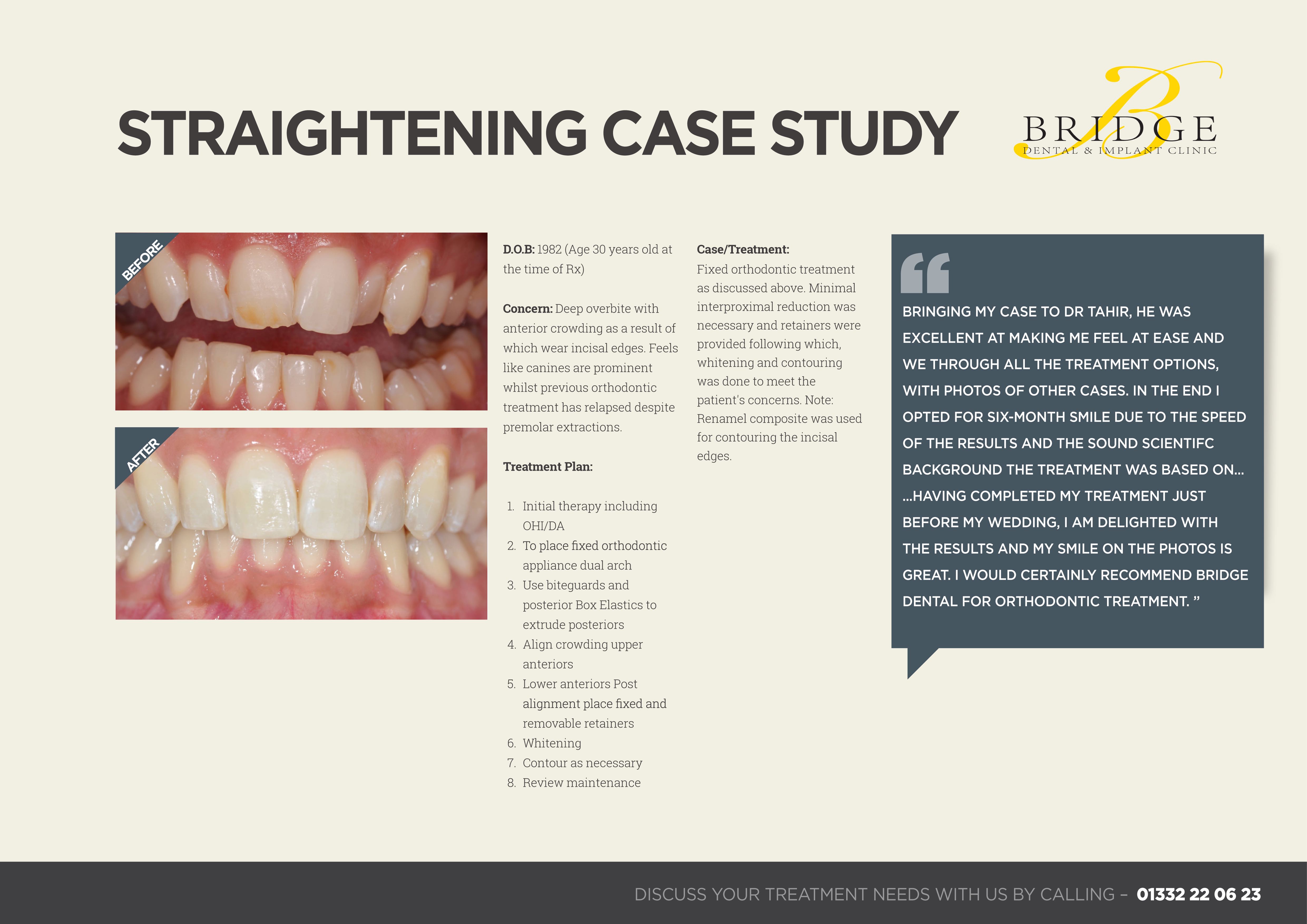Straightening Case Study - Bridge Dental Clinic