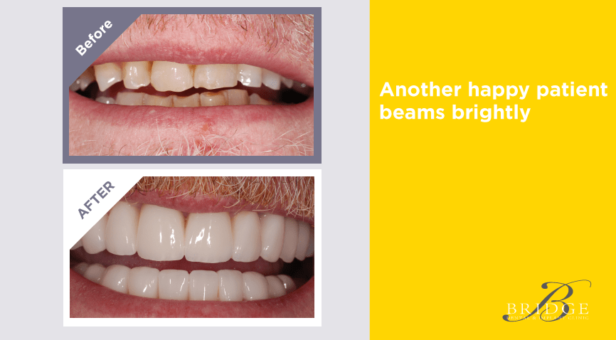 Smile Enhancement - Bridge Dental Clinic