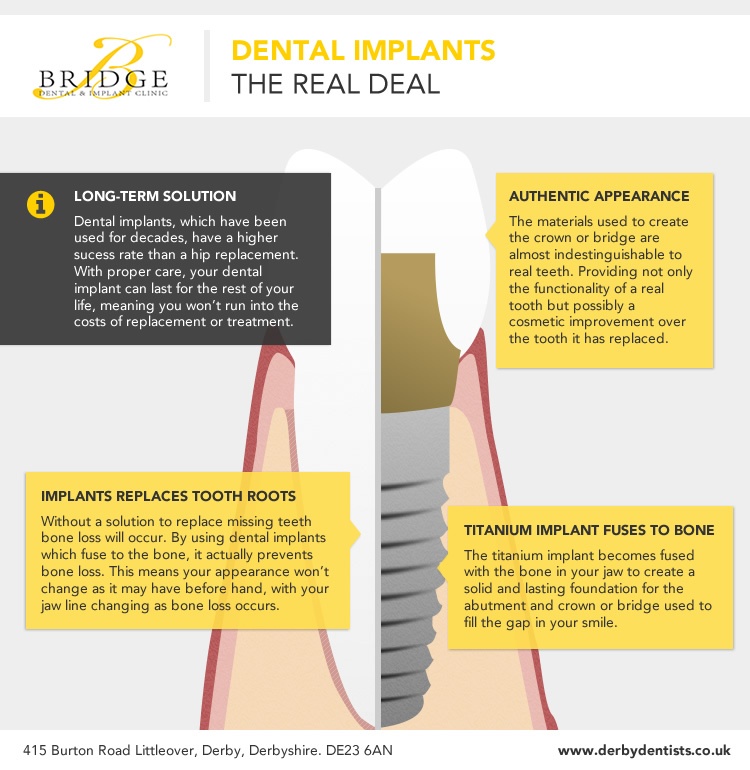 dental-implants-therealdeal