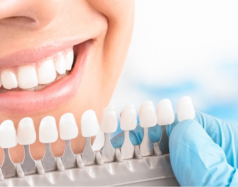Blog -Bridge Dental