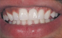 single-dental-implant copy