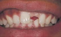 single-dental-implant