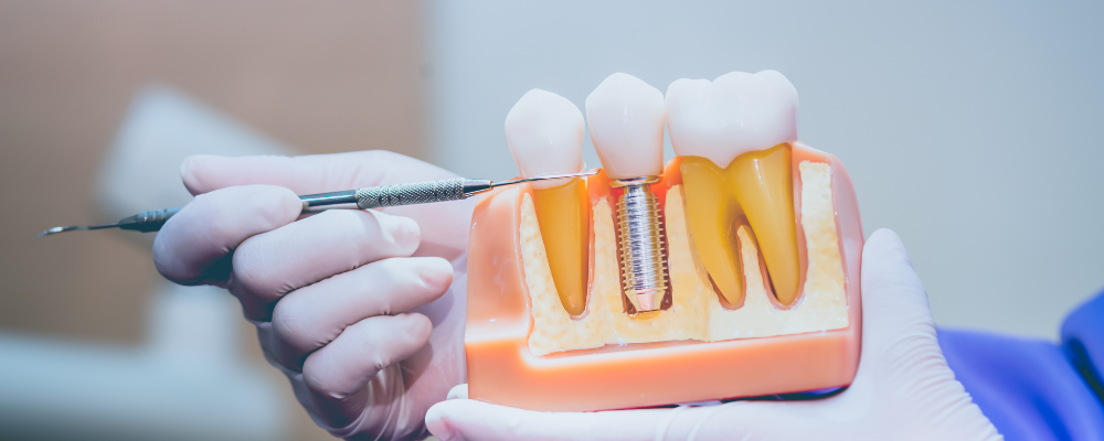 A model of a dental implant titanium screw, showcasing how it works like a natural toothroot