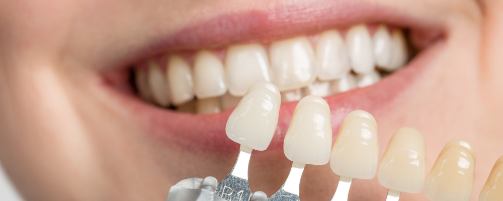 close up image of B1 whitened veneers