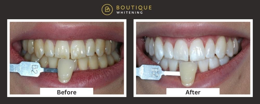 Before and after image of the teeth whitening comparing the contrast between B2 whitening to B1