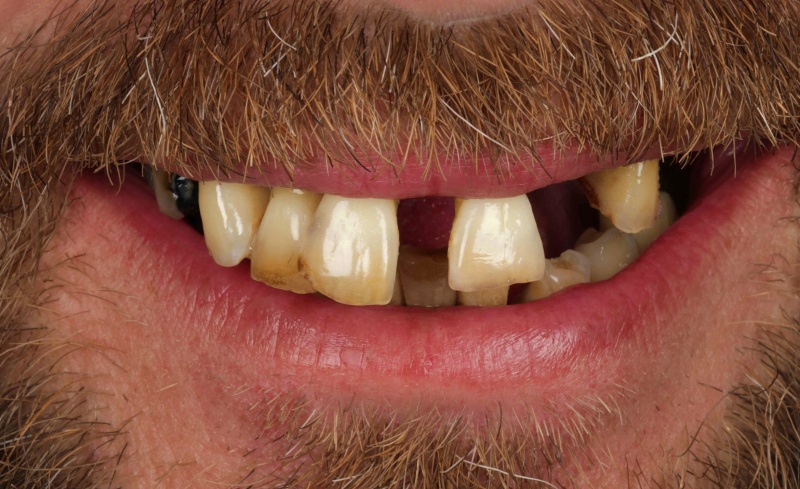 Before - Bridge Dental