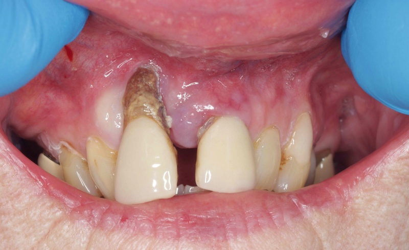 Before - Bridge Dental
