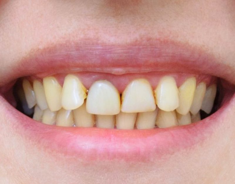 Blog -Bridge Dental