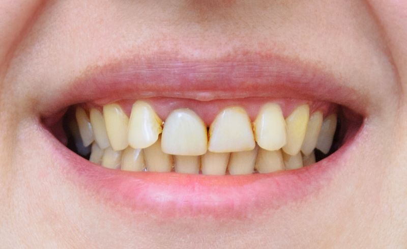 Before - Bridge Dental