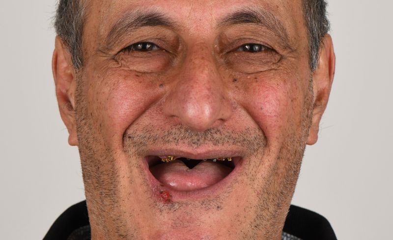 Before - Bridge Dental