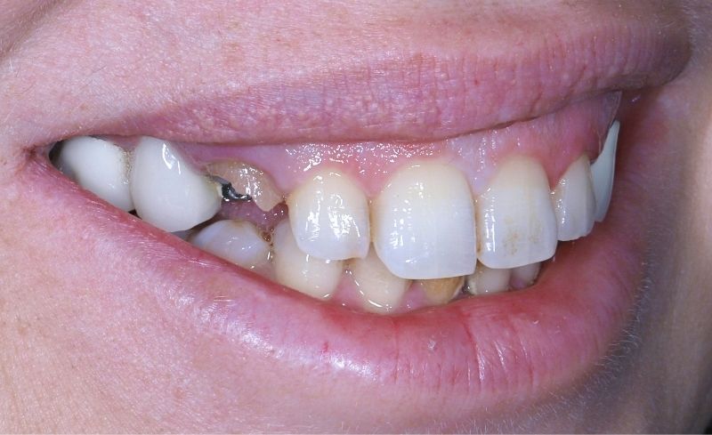 Before - Bridge Dental