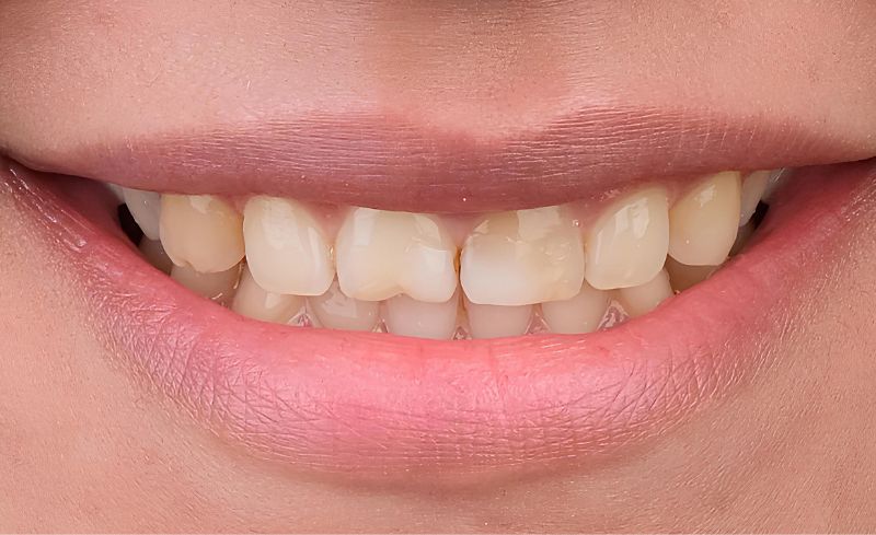 Before - Bridge Dental