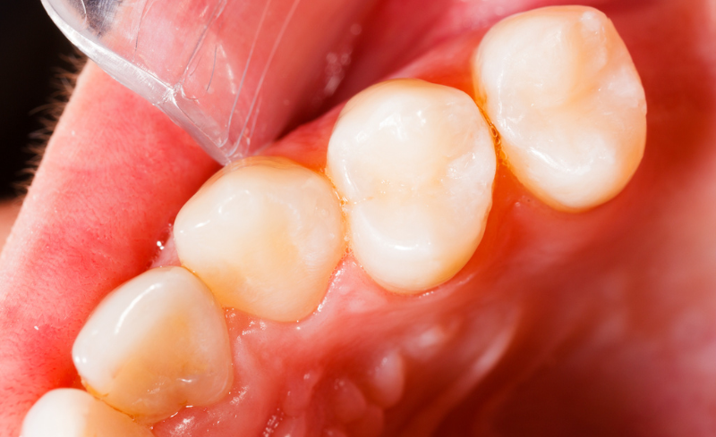 After -Bridge Dental