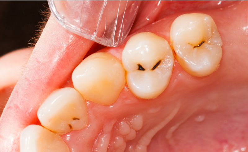 Before - Bridge Dental