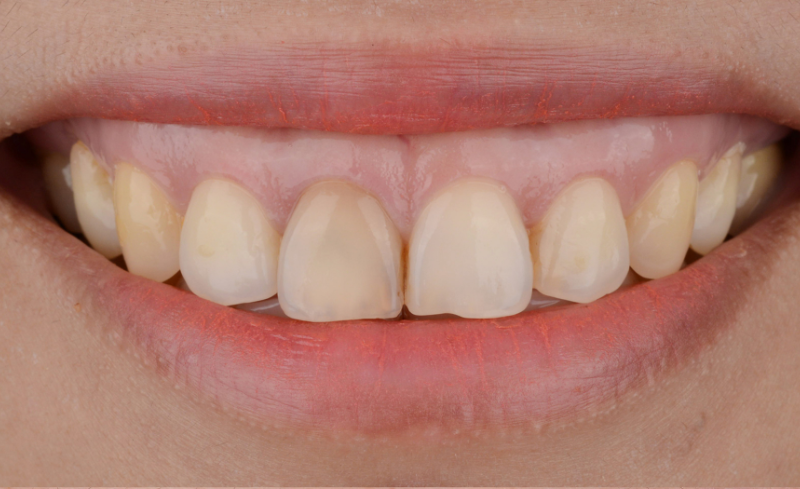 Before - Bridge Dental